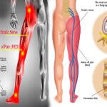 Sciatica Treatment Medicine in Accra, Ghana