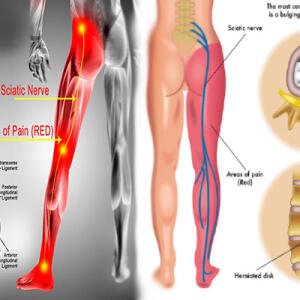 Nerve Pain Treatment Medicine in Accra, Ghana