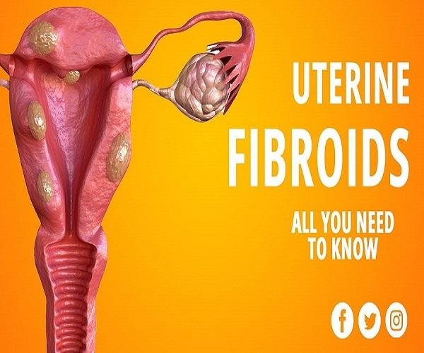 Types of Fibroids: Symptoms | Causes | Treatment Medicine Without Surgery