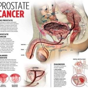 Prostate Cancer Treatment Medicine and Supplements in Accra, Ghana