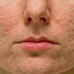 Natural Remedies for Treating Acne Scars: Your Path to Clearer Skin