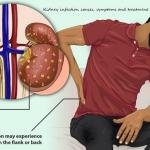 Kidney Infection Treatment Medicine in Accra, Ghana