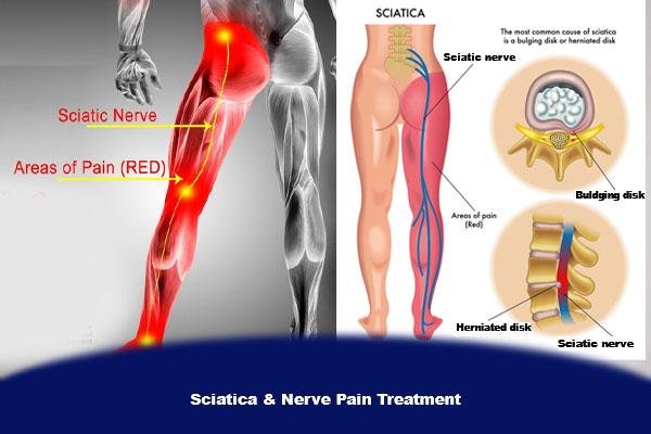 Sciatica 600x400